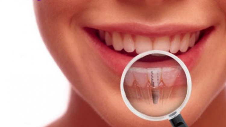 implant dentar