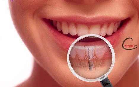 implanturi_dentare_dr.Leahu