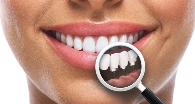 Implantul dentar fast & fixed – principala opțiune pentru înlocuirea dinților lipsă