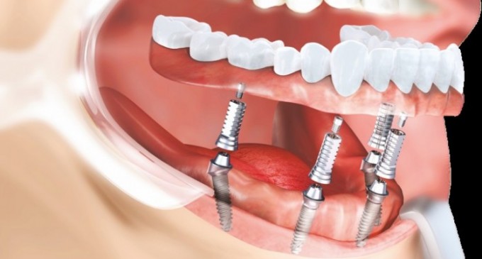 Nu știți dacă aveți nevoie de un implant dentar? Iată aspecte importante ale acestei proceduri